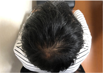 薄毛に悩む30代男性、3ヶ月後、つむじにボリュームが出て頭髪の密度があがりました。